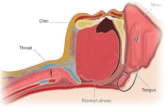 throat with an apnea event